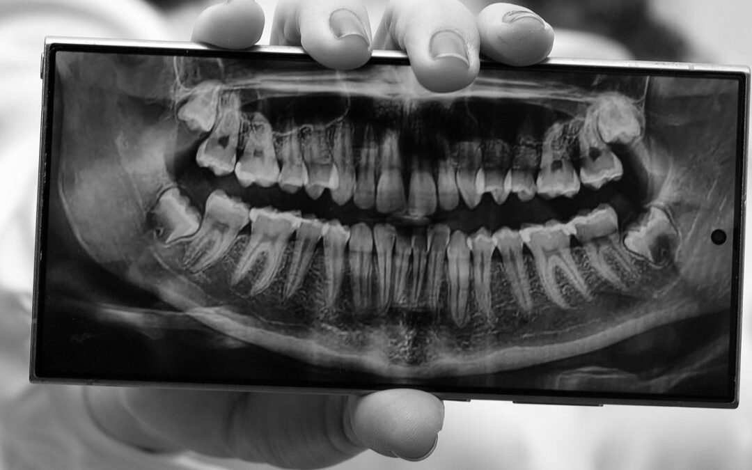 Perodontograma o Periodontograma, ¿Qué es y para que sirve?