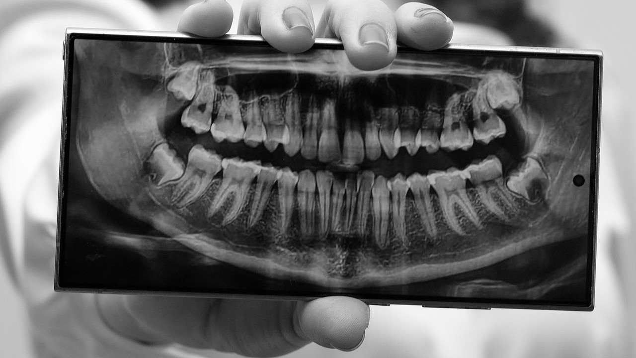 Perodontograma o Periodontograma, ¿Qué es y para que sirve?