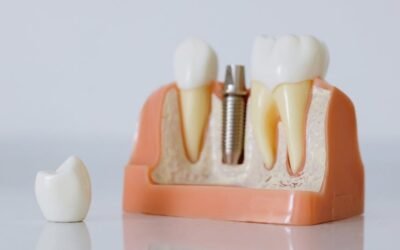 IA en el Diagnóstico Dental: ¿Solo una Moda?